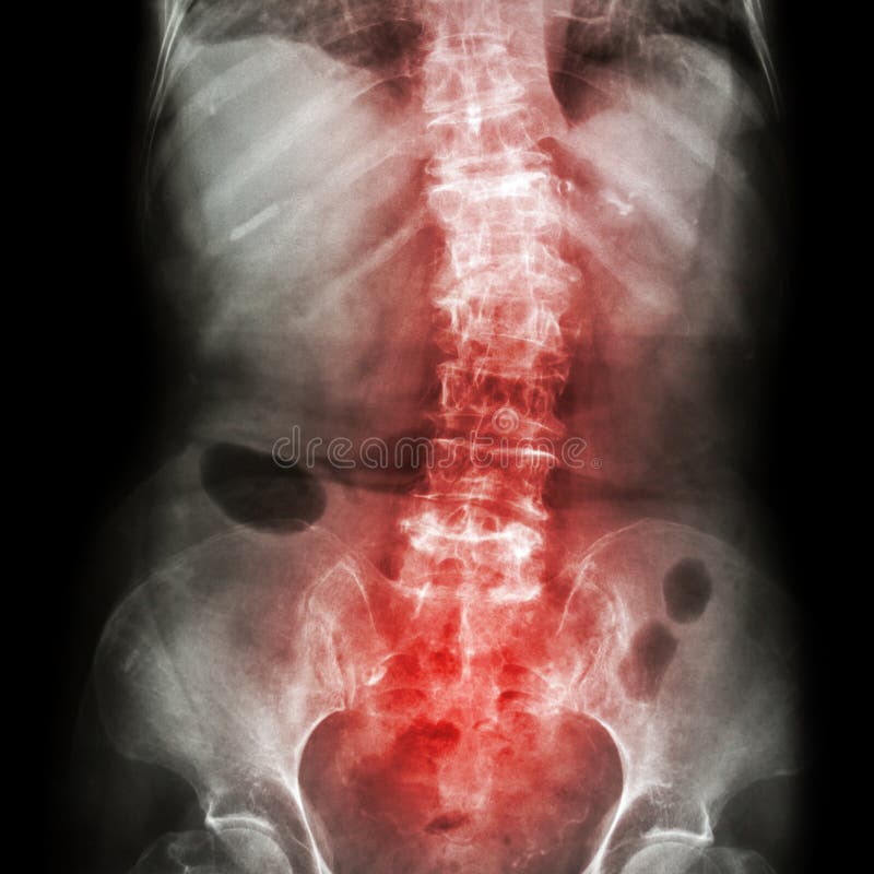 Spondylosis και σκολίωση (των ακτίνων X οσφυικός ταινιών - η σπονδυλική στήλη ιερών οστών παρουσιάζει στριμμένη σπονδυλική στήλη) στοκ εικόνα με δικαίωμα ελεύθερης χρήσης Spondylosis και σκολίωση (των ακτίνων X οσφυικός ταινιών - η σπονδυλική στήλη ιερών οστών παρουσιάζει στριμμένη σπονδυλική στήλη) στοκ εικόνα με δικαίωμα ελεύθερης χρήσης