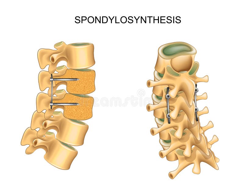 Vector illustration of spondylosynthesis. vertebral osteosynthesis. surgery. Vector illustration of spondylosynthesis. vertebral osteosynthesis. surgery