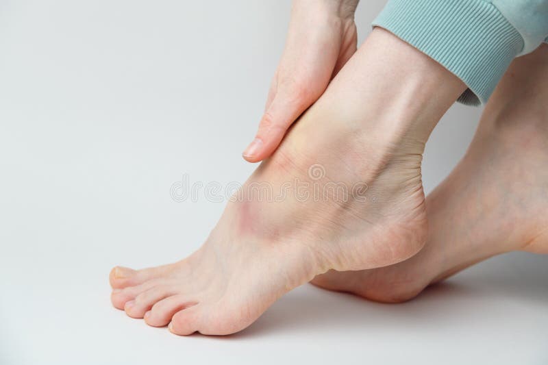 Sprained ankle with bruise and swelling on a female left foot on white background royalty free stock images