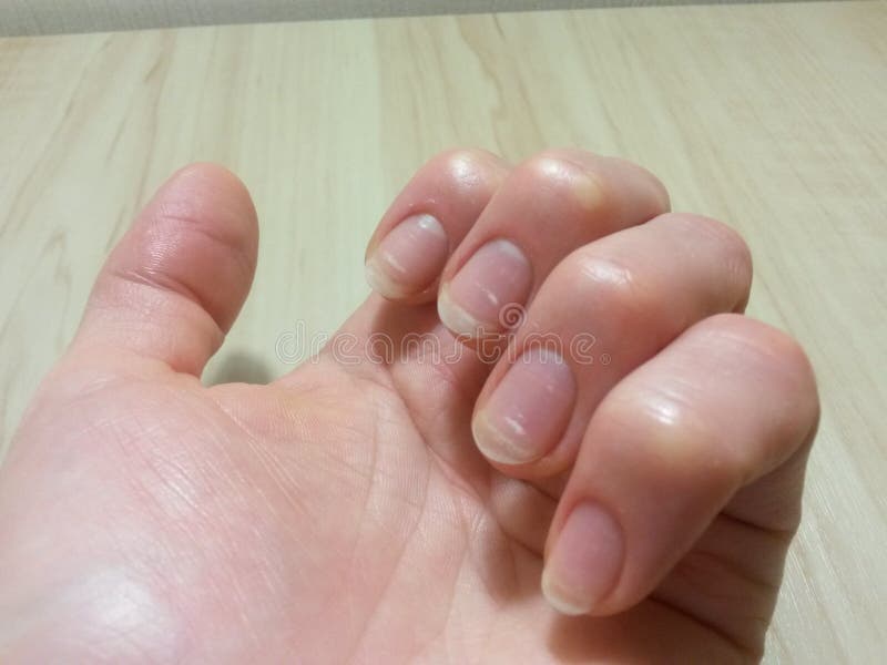 White spots on nails from bartending? Does anyone else get this? Can this  be related to bartending at all? : r/bartenders