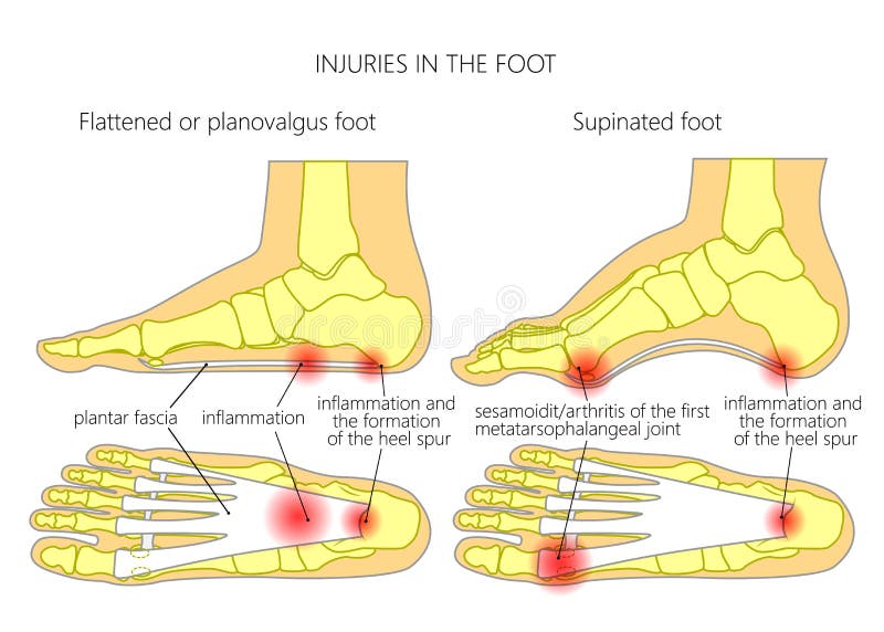 Spur_sesamoidit plantar del fasciitis_heel libre illustration Spur_sesamoidit plantar del fasciitis_heel libre illustration