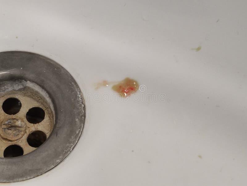 Sputum or saliva with blood in a sink. Sputum or saliva with blood in a sink