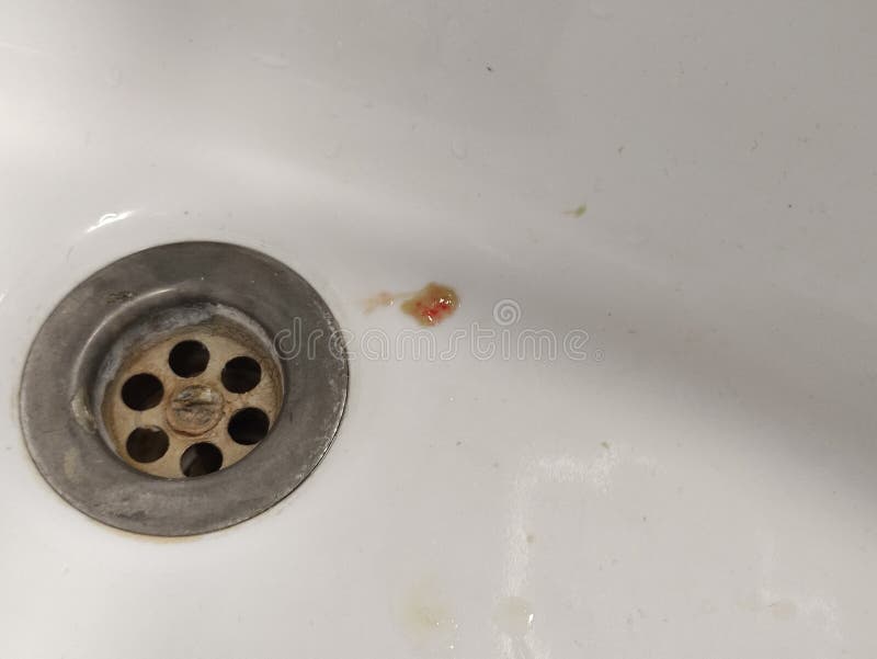 Sputum or saliva with blood in a sink. Sputum or saliva with blood in a sink