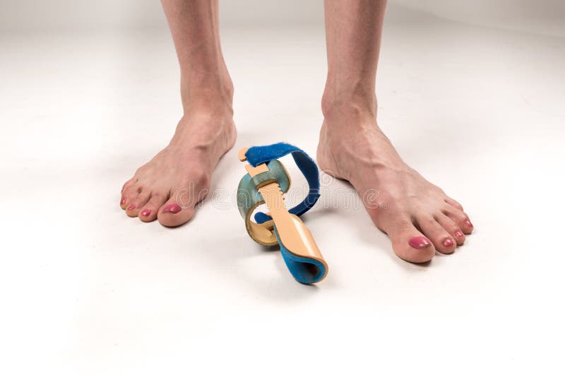 Stabilizing orthosis for the correction of the big toe on the woman legs when hallux valgus, 2 legs, close-up isolated, white royalty free stock images Stabilizing orthosis for the correction of the big toe on the woman legs when hallux valgus, 2 legs, close-up isolated, white royalty free stock images