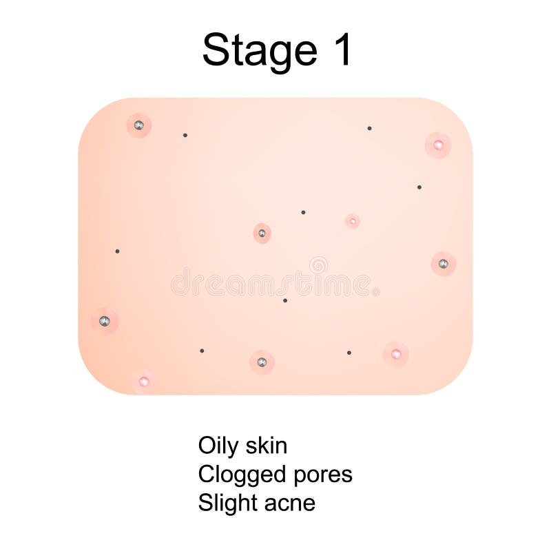 Stage 1 of Development of Acne. Inflamed Skin with Scars, Acne and ...