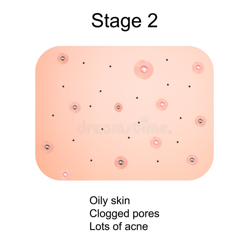 Stage 2 Of Development Of Acne Inflamed Skin With Scars Acne And