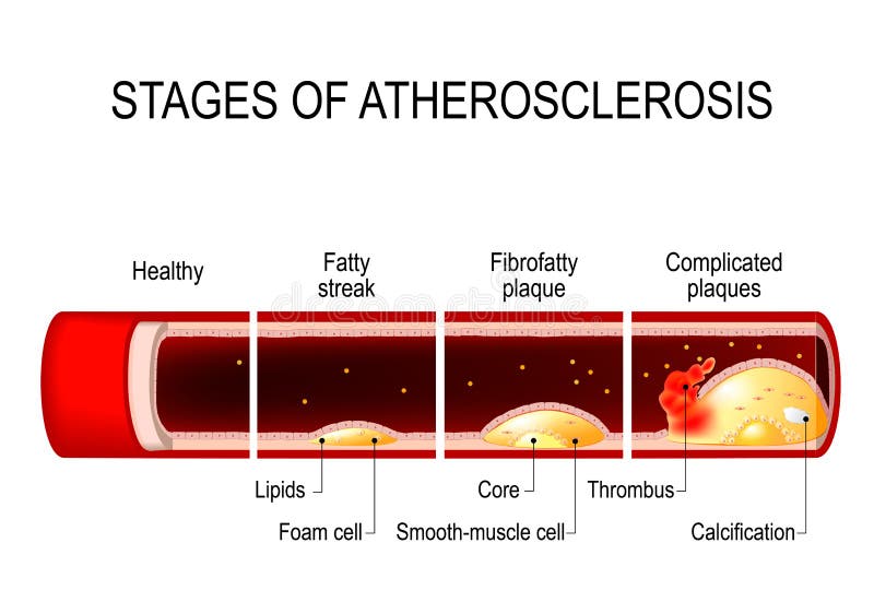 Stages of atherosclerosis