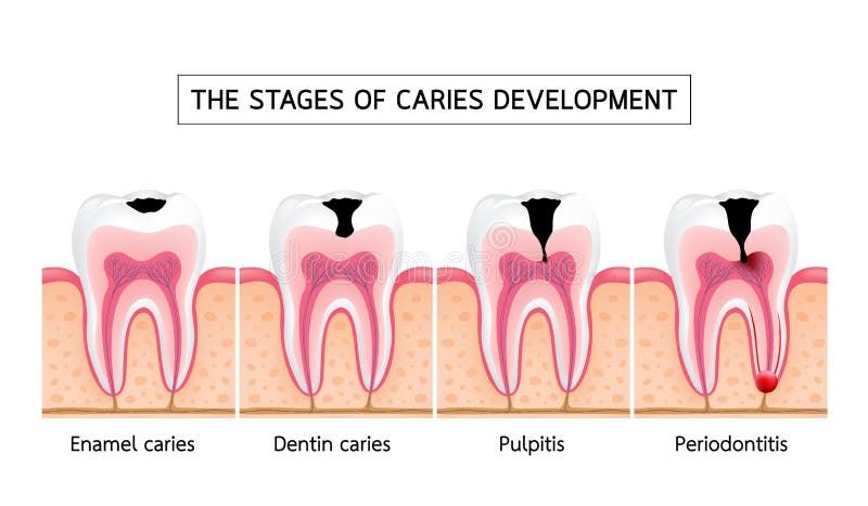 Stages of Caries Development. Stock Vector - Illustration of dental ...