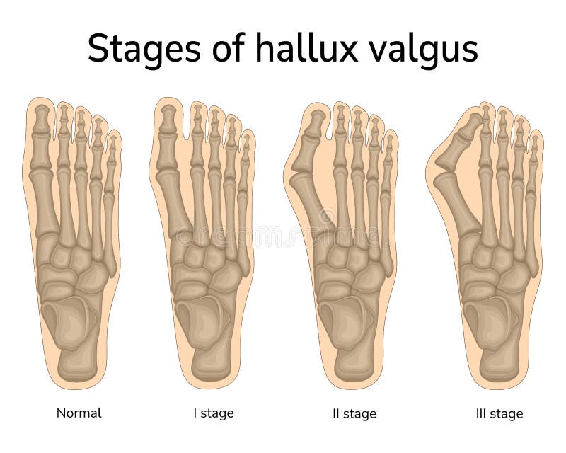 Stages of hallux valgus stock vector. Illustration of medicine - 245942598