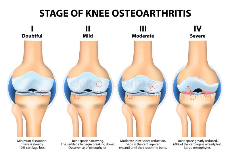 Etapy koleno Osteoartrózy (OA).