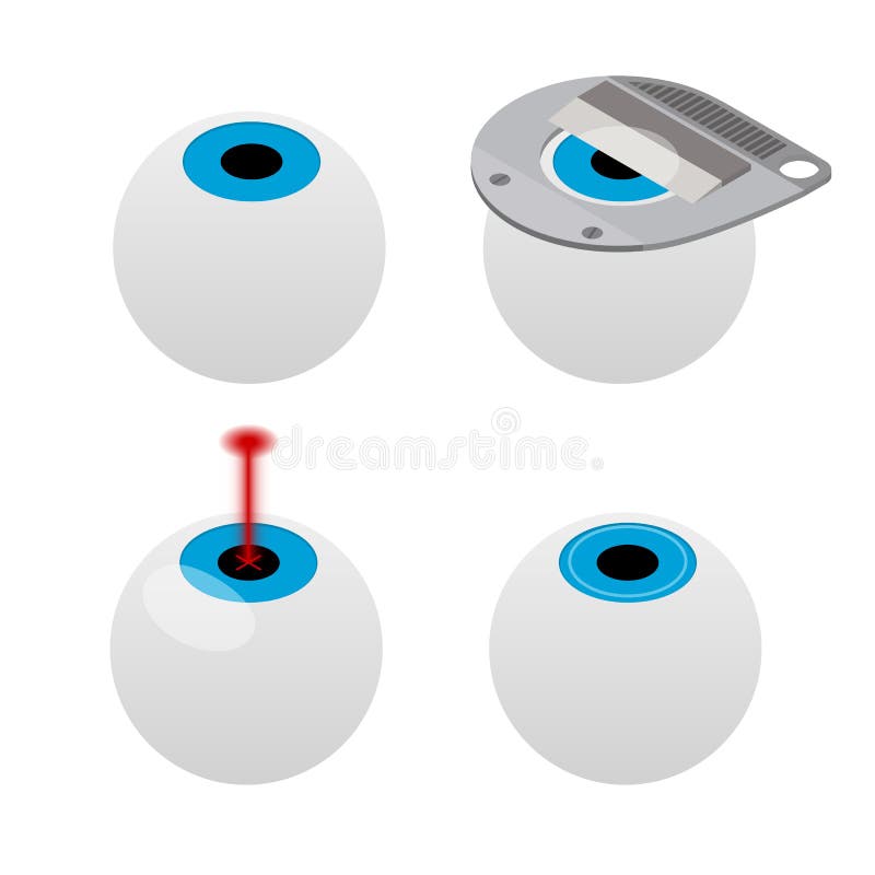 Stages of laser vision correction isometric vector illustration vector illustration