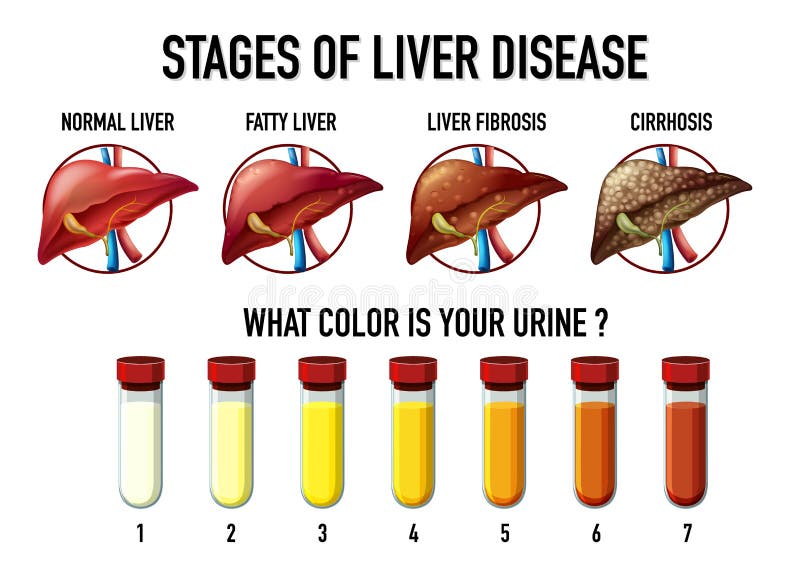 Stages Of Liver Disease Leading To Cirrhosis Stock Vector