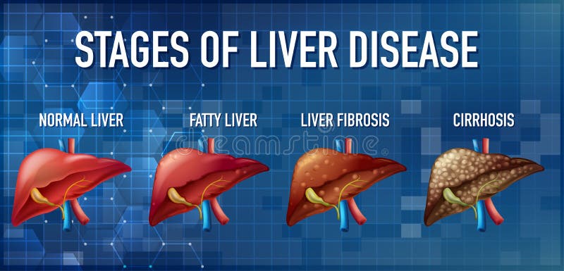 Stages of Liver Damage from Healthy, Fatty Liver, Fibrosis, Cirrhosis ...