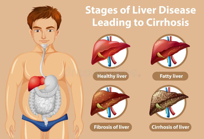 Stages Of Liver Disease Leading To Cirrhosis Stock Vector