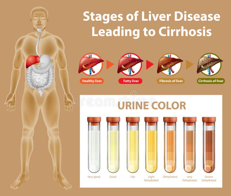 Stages Of Liver Disease Leading To Cirrhosis Stock Vector