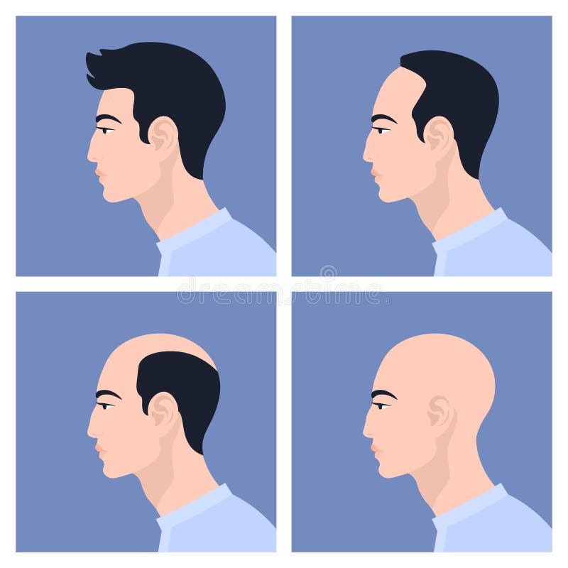Stages of Male Pattern Baldness. Hair Loss. Alopecia Stock Illustration -  Illustration of ethnicity, bald: 121781883