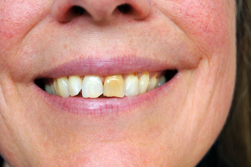 Osoby s úsměvem s barevnou žluté zuby přímo v přední části.