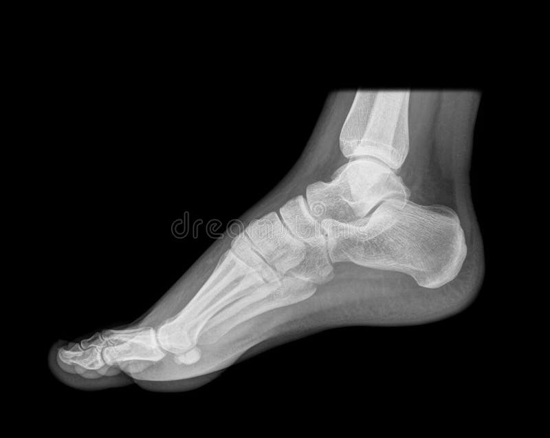 Standing foot on xray stock photo. Image of diagnosis 14111604