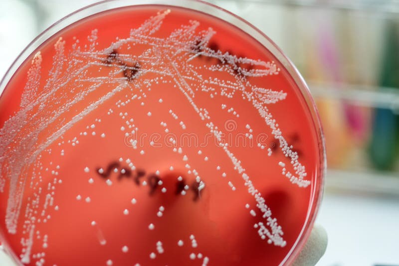 Case Of Staphylococcal Toxic Shock Syndrome After Cs