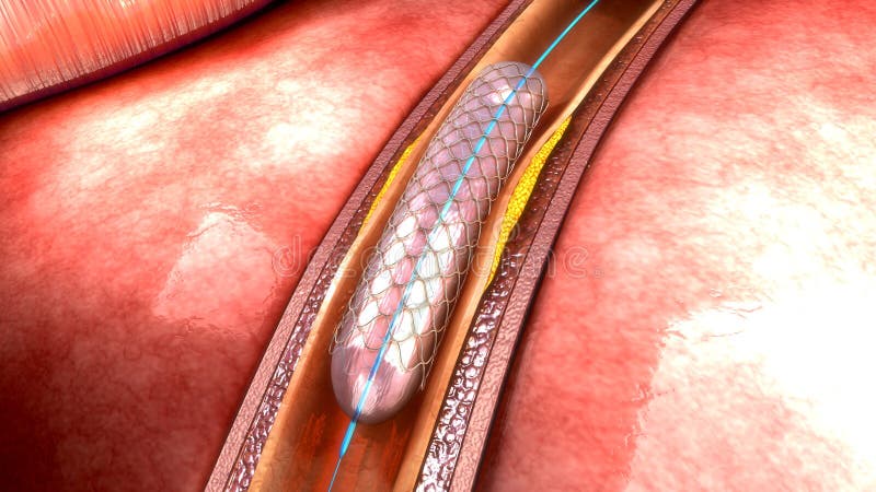 Stent arkivbild Stent arkivbild