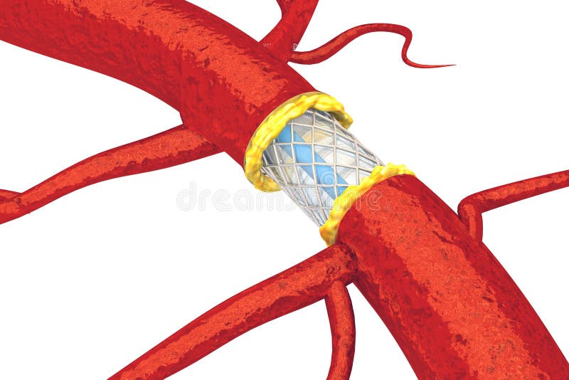 Stent angioplasty vector illustration