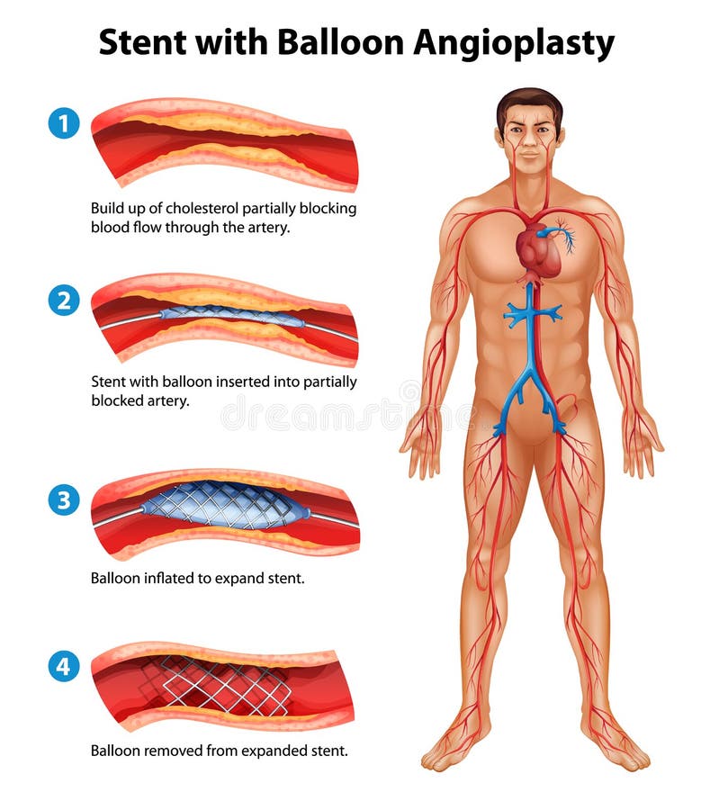 Stentangioplastytillvägagångssätt vektor illustrationer Stentangioplastytillvägagångssätt vektor illustrationer