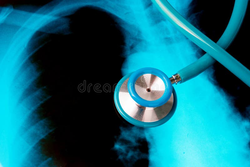 Stethoscope on a Xray Photo of Lungs Stock Photo Image of cigarettes