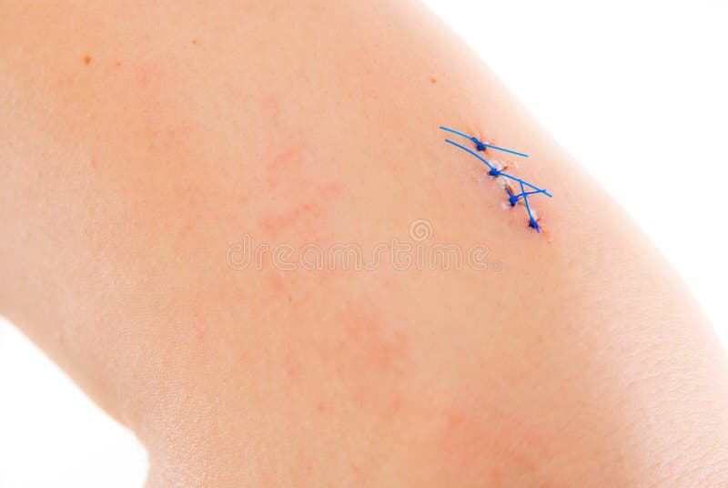 Stitched up injury stock photo. Image of hurt, hand, body 13325534