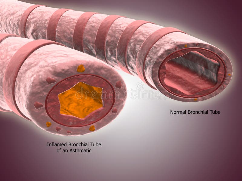 Trachea cross-section showing normal and asthmatic bronchiole. royalty free illustration