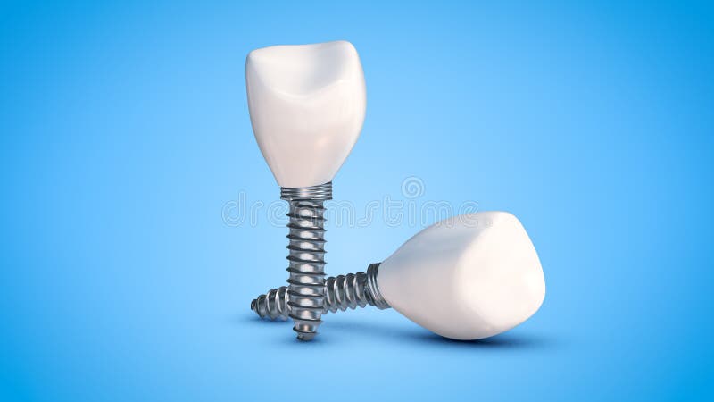 Tooth and dental implant for surgery concept stock illustration