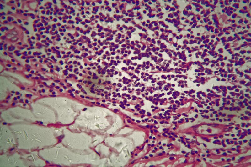 Stanford scientists make leukemia 'grow up' and eat itself