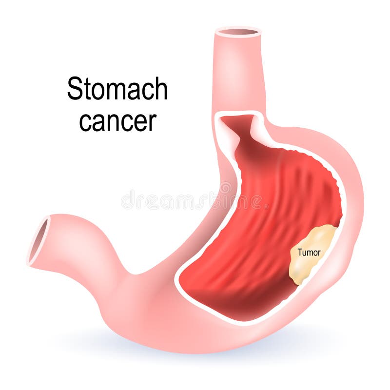 Stomach Cancer. Cross Section Of The Stomach Stock Vector ... helicobacter pylori esophagus diagram 