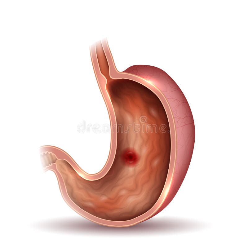 Stomach Ulcer  Interanl Organs Anatomy Colorful Drawing