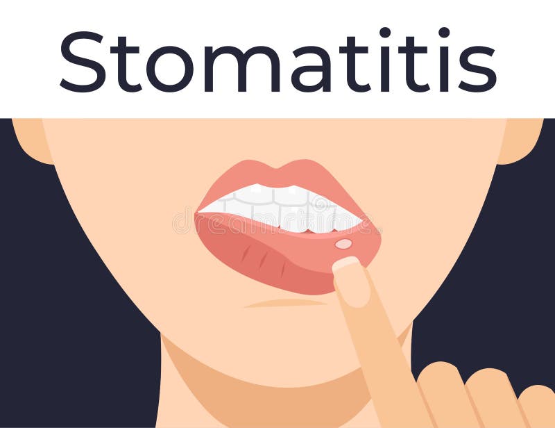Stomatitis woman lips