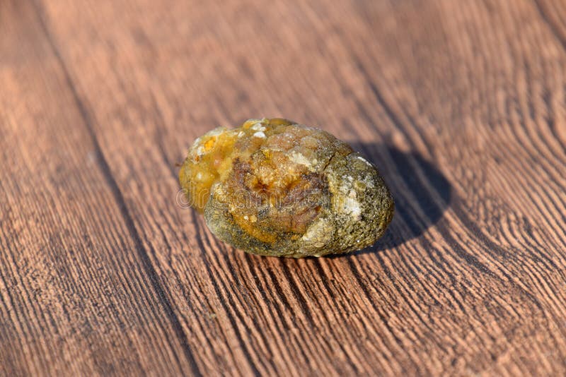 Stone of Gallbladder. the Result of Gallstones. a Calculus of
