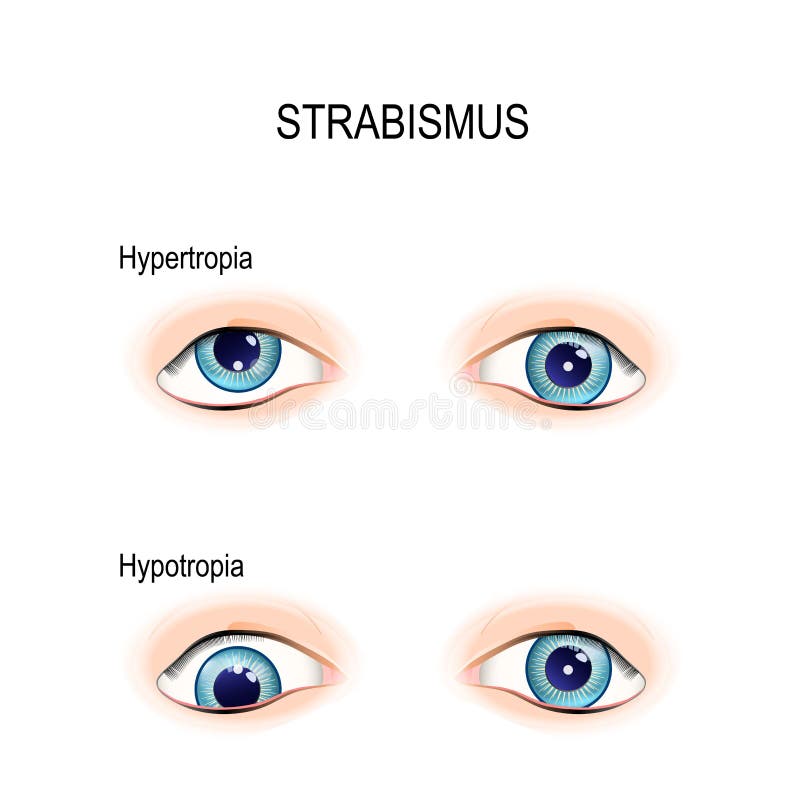 Strabismus. crossed eyes stock vector. Illustration of medical 102946882