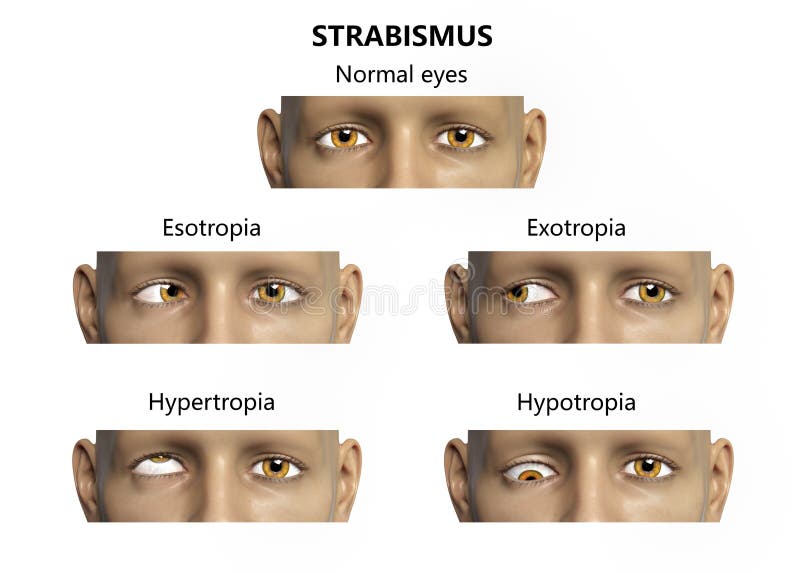 Strabismus, Eyes Deviation, Illustration Stock Illustration