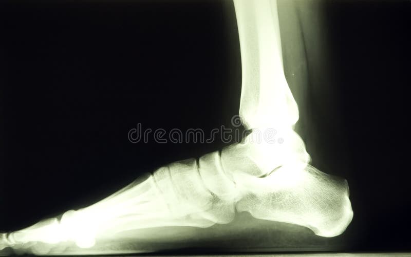 X ray image of 30 year old female foot. X ray image of 30 year old female foot