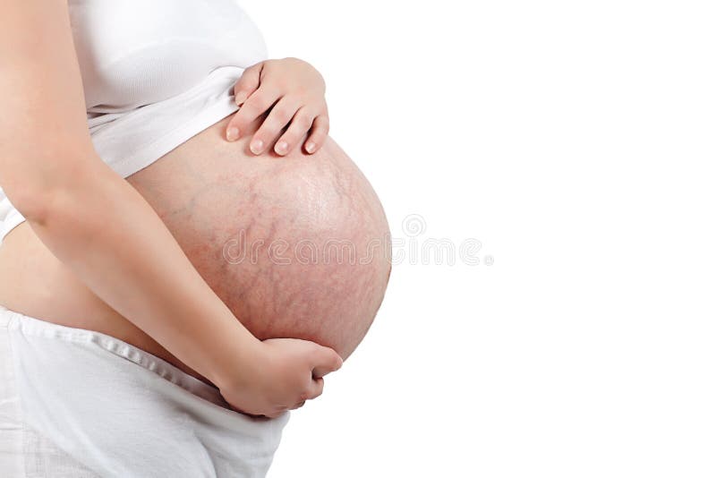 Stretch marks on pregnant woman s bump