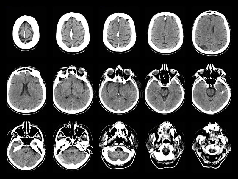 Qual Valor De Uma Tomografia Da Cabeça Stroke on CT scans stock photo. Image of brain, groove - 48558842