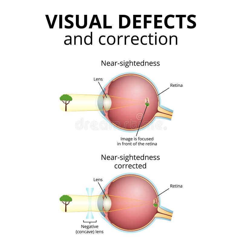 Visual Impairment As a Symptom of Disease Stock Vector Illustration of overworked, focusing