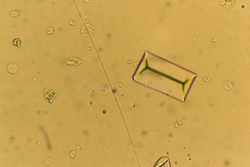 Urine Crystals, Red Blood Cells and Leukocytes at the Microscope