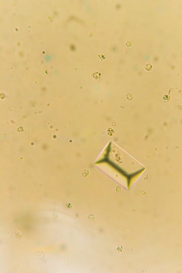 Urine Crystals, Red Blood Cells and Leukocytes at the Microscope