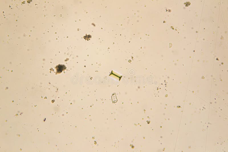 Urine Crystals, Red Blood Cells and Leukocytes at the Microscope