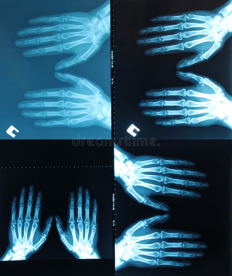 X-ray scanning. X-ray picture (radiograph). X-ray scanning. X-ray picture (radiograph)