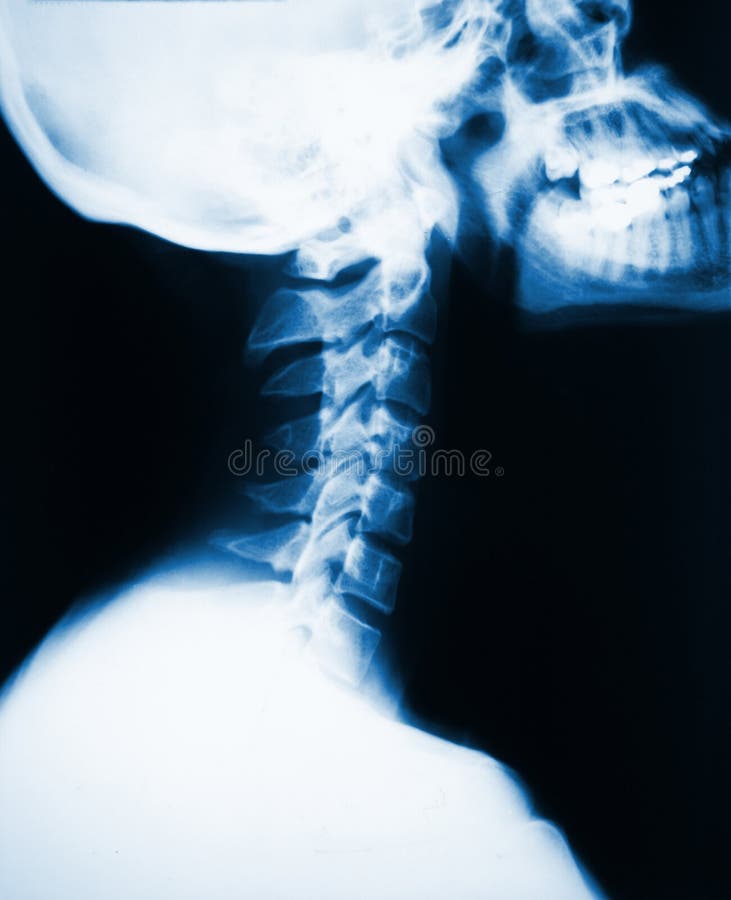 Detail of neck x-ray image. Detail of neck x-ray image