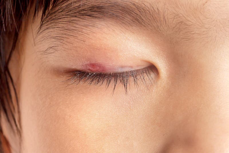 Stye eye infection royalty free stock image Stye eye infection royalty free stock image