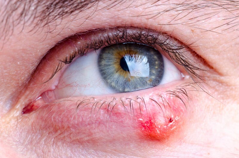 Stye hordeolum disease on eye of a caucasian female royalty free stock photo