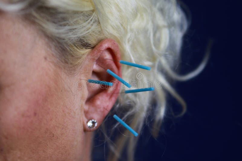 Stäng sig upp av det mänskliga kvinnliga örat med blåa visare: Öraakupunktur som en form av alternativ kinesisk medicin royaltyfria foton Stäng sig upp av det mänskliga kvinnliga örat med blåa visare: Öraakupunktur som en form av alternativ kinesisk medicin royaltyfria foton