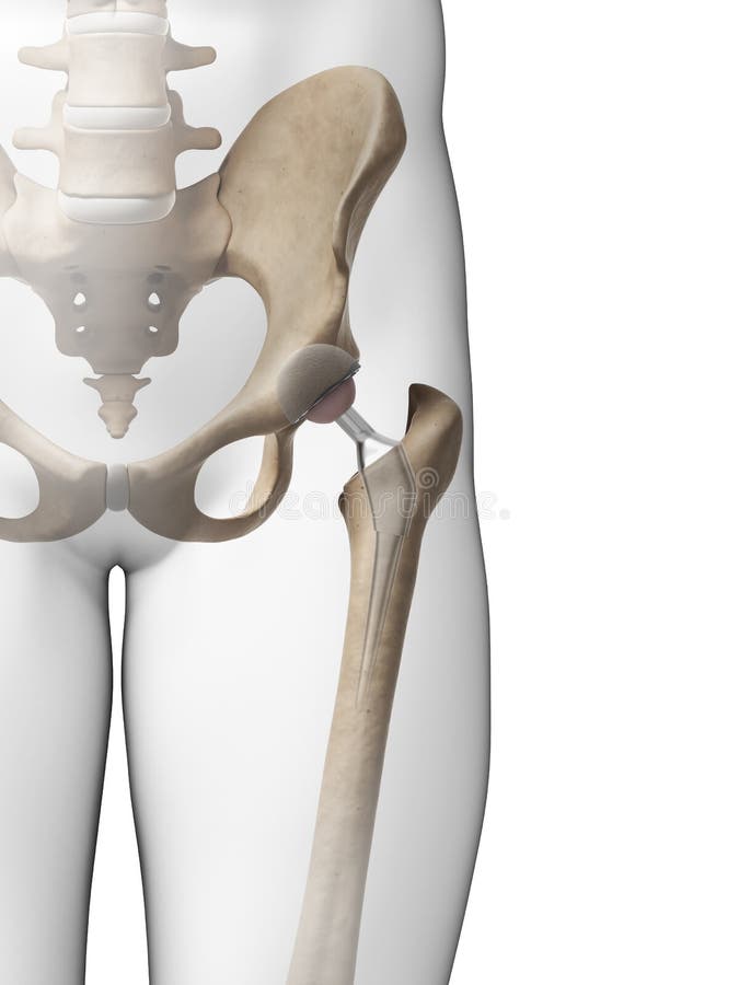 3d rendered illustration of a hip replacement. 3d rendered illustration of a hip replacement